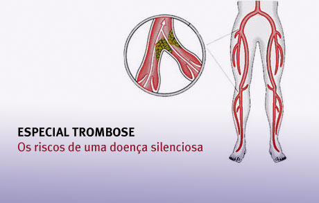 Especial Tromboembolismo