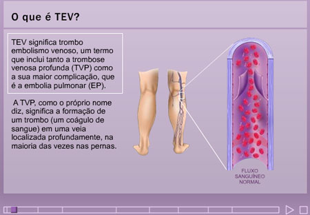 Trombose